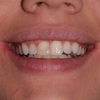 Composite Bonding - Smile 3 before